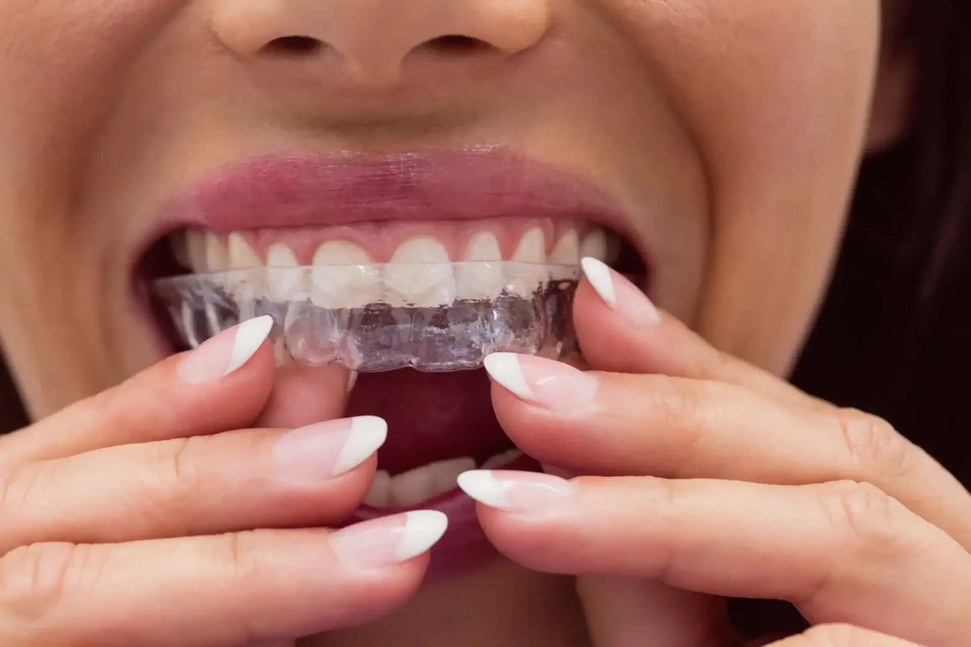 Digital iTero scan of a patient's teeth used to plan Invisalign treatment