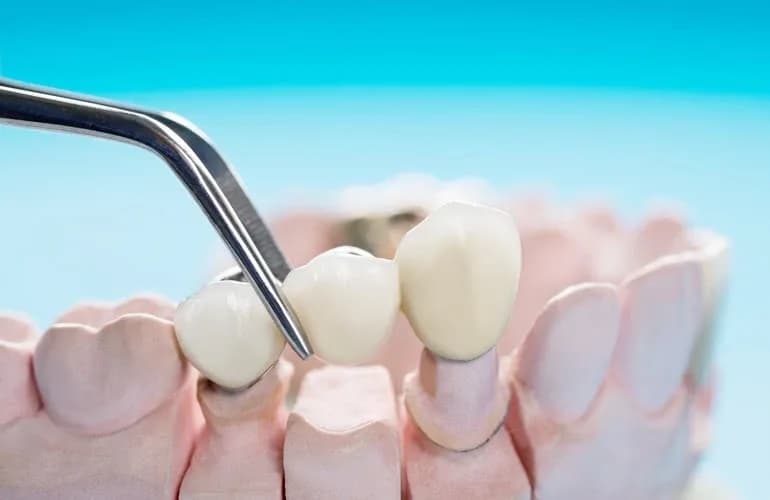 Dental Crown Procedure Equipment - Neola Dental