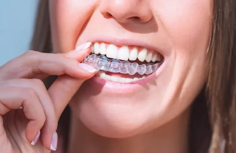 Close-up of a woman with a flawless white smile - porcelain and composite veneers at Neola Dental in Minneola, FL