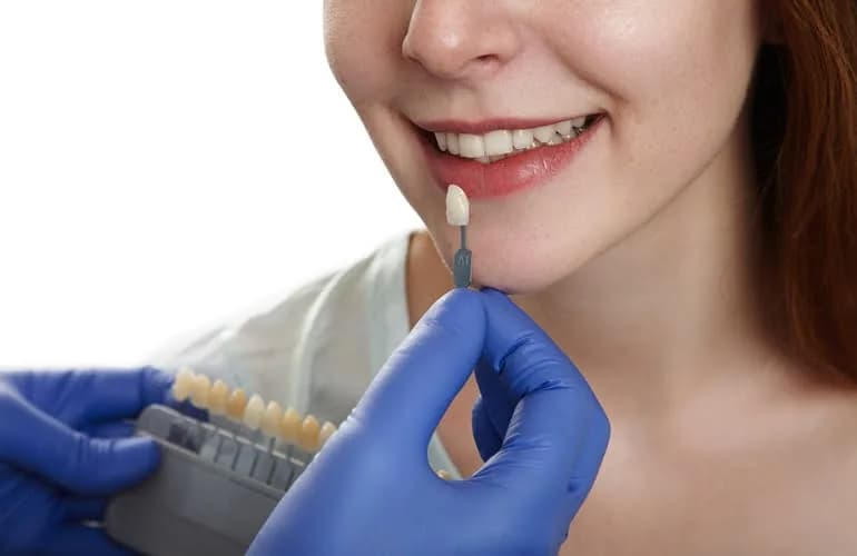 porcelain veneers article