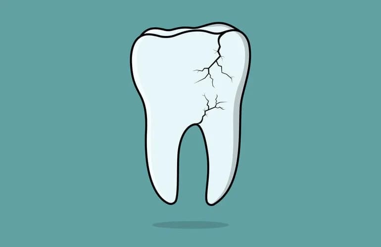 How to fix a cracked tooth: your complete guide