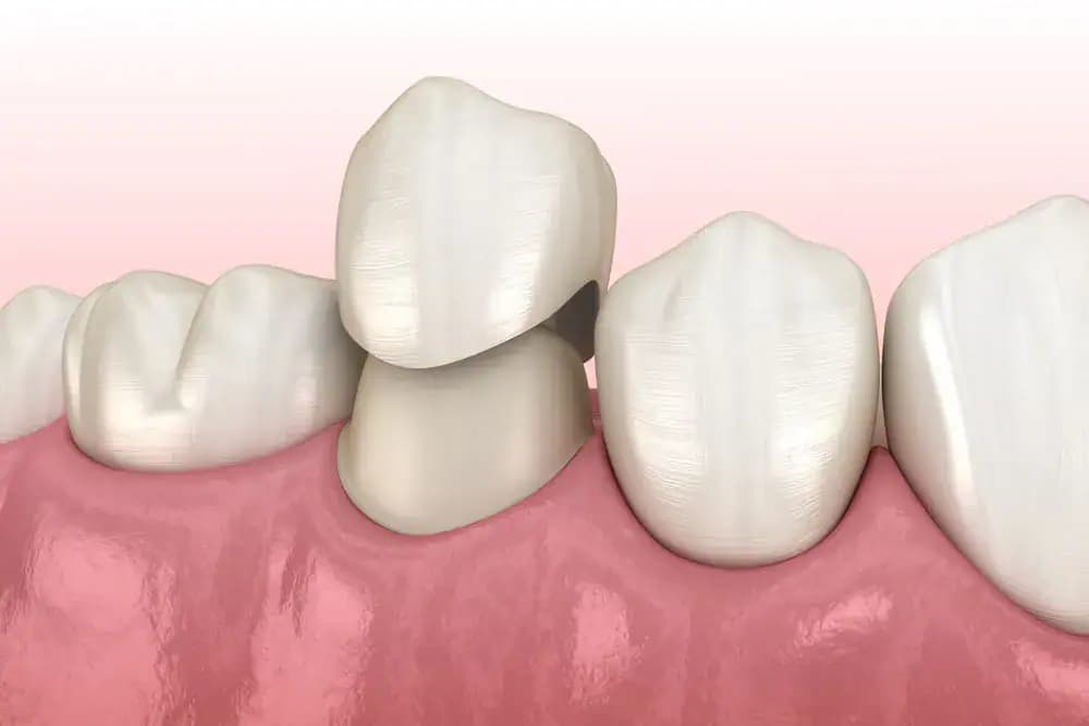 BruxZir Zirconia Crown - Neola Dental