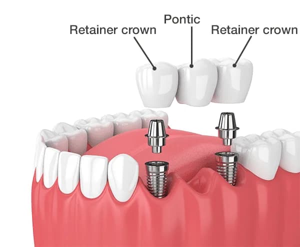 Diagram of an implant-supported dental bridge with two retainer crowns and a pontic over dental implants at Neola Dental, Minneola, FL