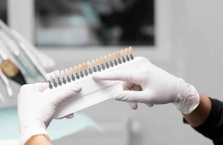 Differences between composite and porcelain veneers