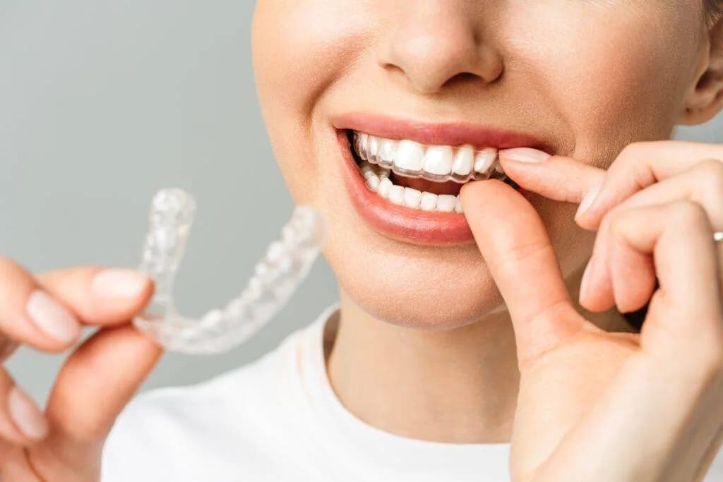 Teeth Whitening Trays at home, FL at Neola Dental in Minneola, FL